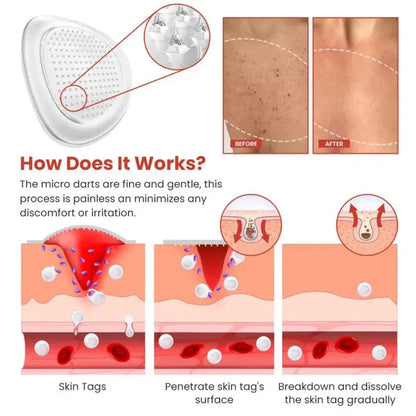 Derma Smooth Skin Tag Removal Patch | Buy 1 Get 1 Free |